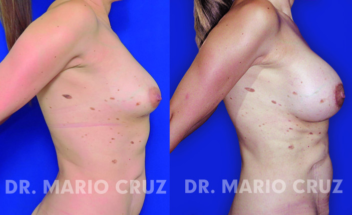Aumento de senos con implantes aumentosenos.jpg