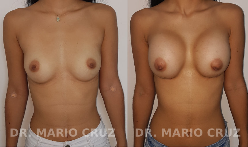 Aumento de senos con implantes aumentosenos4.jpg