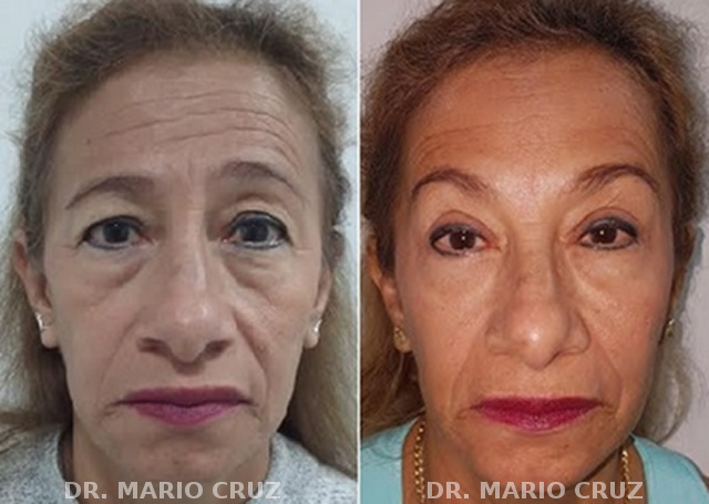 Cirugía de parpados (bleforoplastia) blefaroplastia.jpg