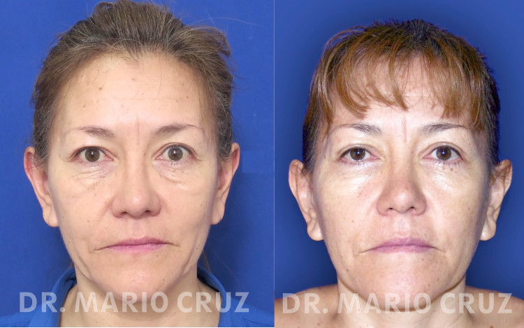 Cirugía de parpados (bleforoplastia) blefaroplastiafrontal.jpg