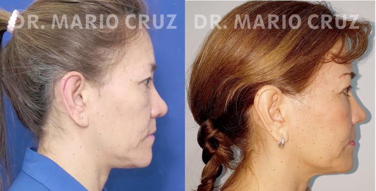 Cirugía de parpados (bleforoplastia) blefaroplastialateral.jpg