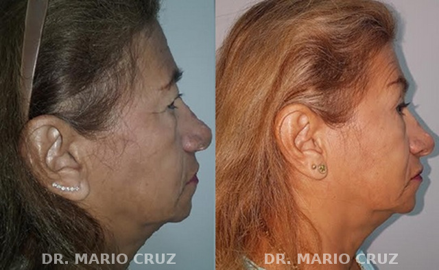 Cirugía de parpados (bleforoplastia) blefaroplastialateral2.jpg
