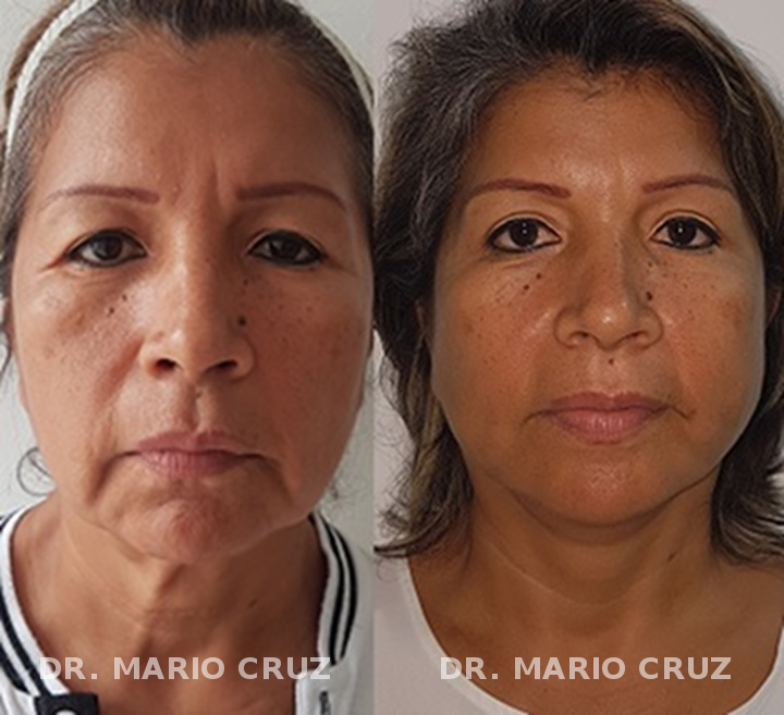 Cirugía de rejuvenecimiento facial (Ritidoplastia) cirugia_de_rejuvenecimiento_facial_ritidoplastia_frontal_1.jpg