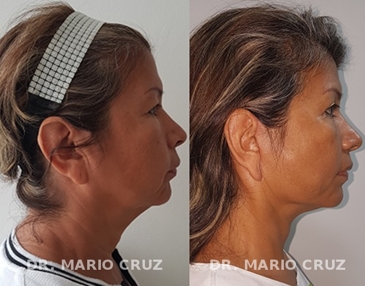 Cirugía de rejuvenecimiento facial (Ritidoplastia) cirugia_de_rejuvenecimiento_facial_ritidoplastia_lateral_1.jpg