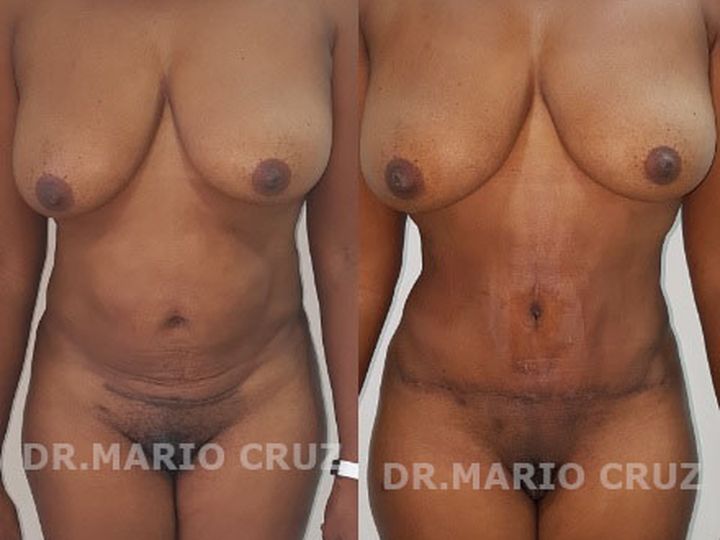 Abdominoplastia (Lipectomia) exp1807281724135b5ced0d3f857.jpg