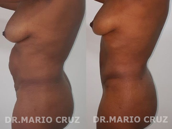 Abdominoplastia (Lipectomia) exp1807281726055b5ced7d24e6e.jpg