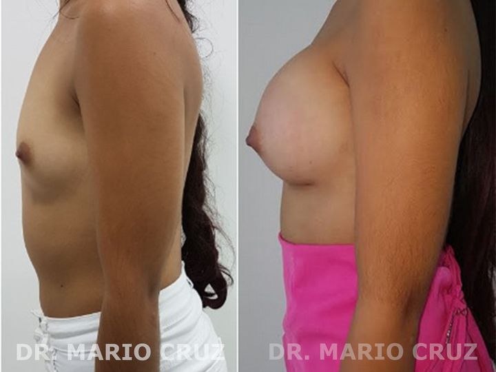 Aumento de senos con implantes exp1807281730455b5cee954cbc3.jpg