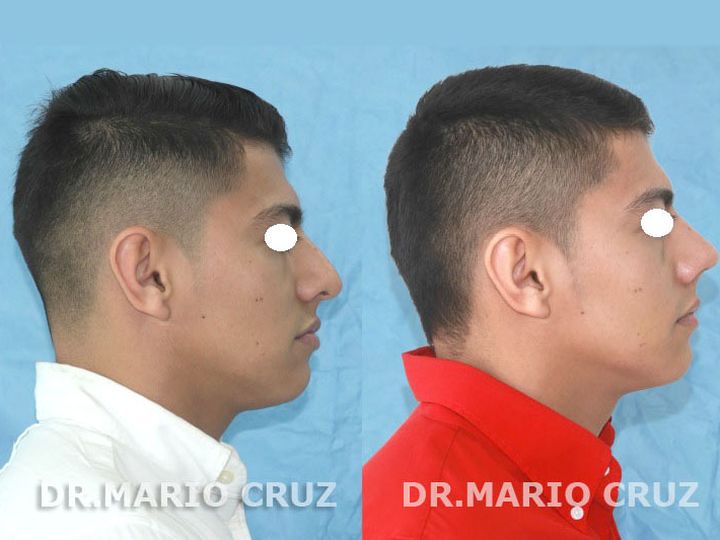Cirugía de nariz (Rinoplastia) exp1807281744585b5cf1eaa1194.jpg