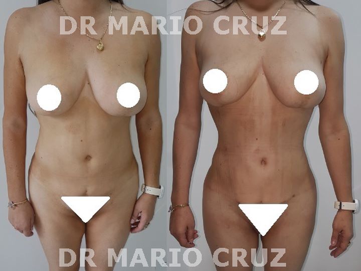 Lipoescultura (Liposucción) exp1810071236155bba440fe1d91.jpg