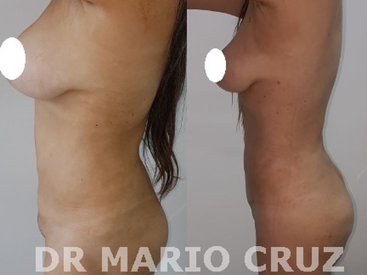 Lipoescultura (Liposucción) exp1810071304505bba4ac237d52.jpg