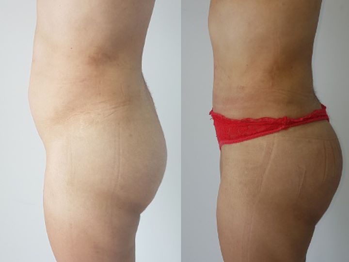 Abdominoplastia (Lipectomia) exp1812081356195c0c13d3d63f8.jpg