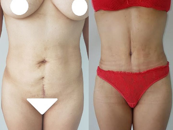 Abdominoplastia (Lipectomia) exp1812081358555c0c146f16d72.jpg