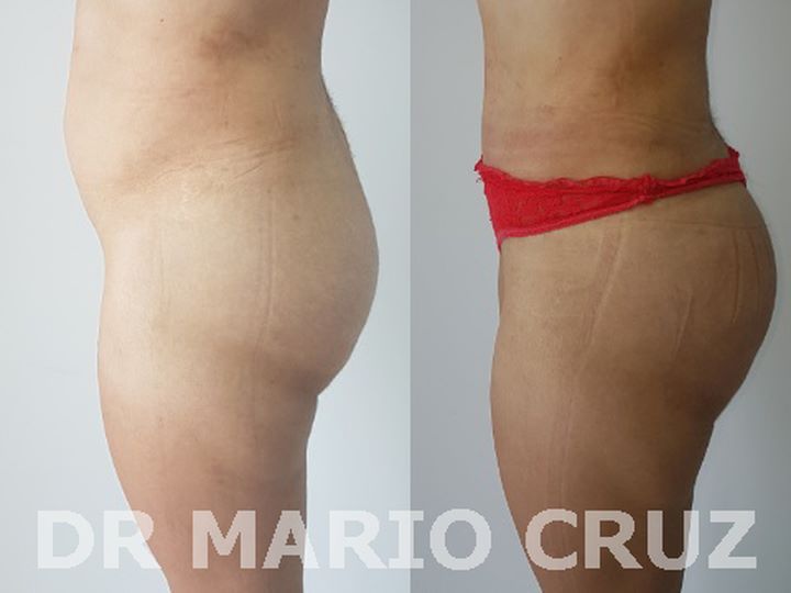 Aumento de glúteos (Gluteoplastia) exp1812081408495c0c16c19b259.jpg