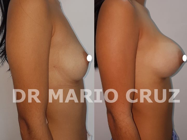 Aumento de senos con implantes exp1812221343015c1e85b51c1cf.jpg