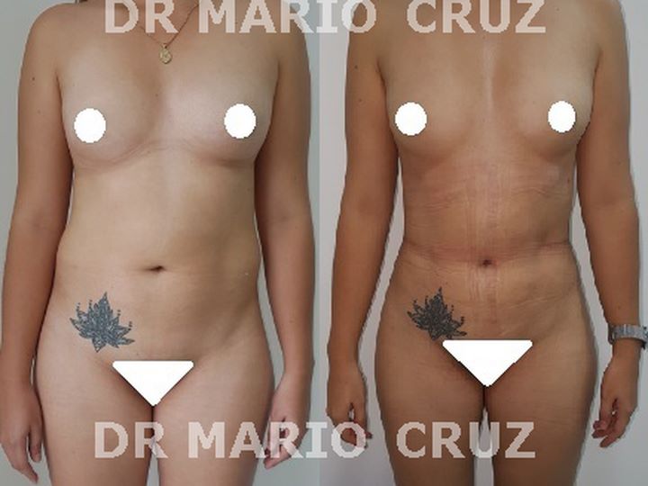 Lipoescultura (Liposucción) exp1901131159025c3b6e56bb8e6.jpg