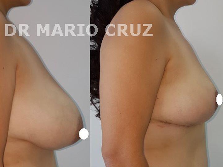 Reducción de senos (Mamoplastia de reducción) exp1901131355235c3b899b39494.jpg