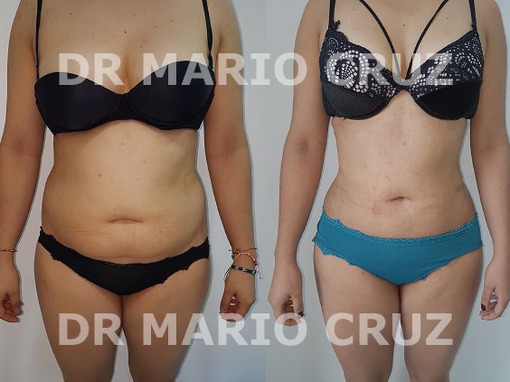 Lipoescultura (Liposucción) exp1904211334195cbcb7ab49e63.jpg