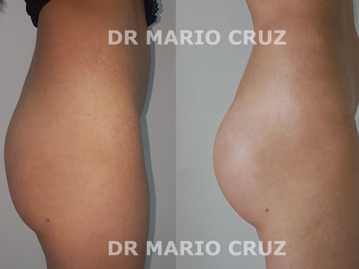 Aumento de glúteos (Gluteoplastia) exp1911042331555dc0fb3beec5d.jpg