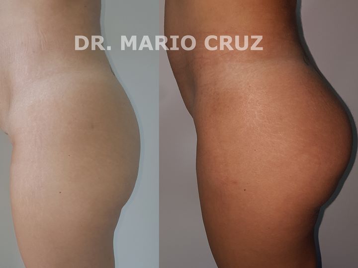 Aumento de glúteos (Gluteoplastia) exp1911042347395dc0feeb2538b.jpg
