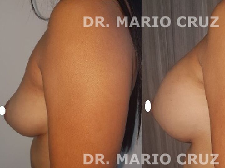 Aumento de senos con implantes exp2005161651445ec06070d28fc.jpg