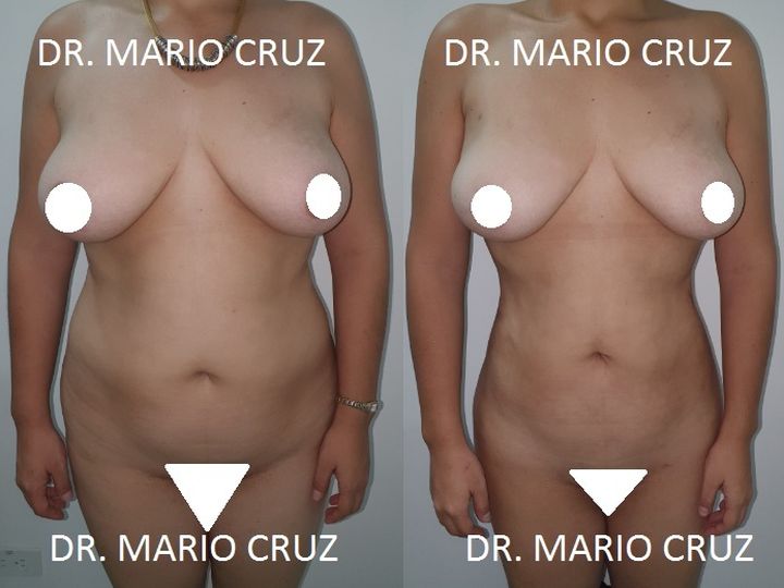 Lipoescultura (Liposucción) exp2005240849145eca7b5ac6b37.jpg