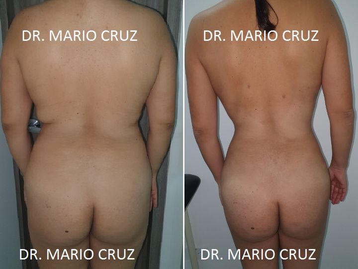 Lipoescultura (Liposucción) exp2005240851255eca7bdd0d938.jpg