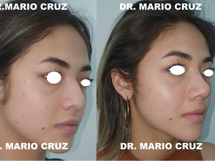 Cirugía de nariz (Rinoplastia) exp220321150407623893e75a9e5.jpg