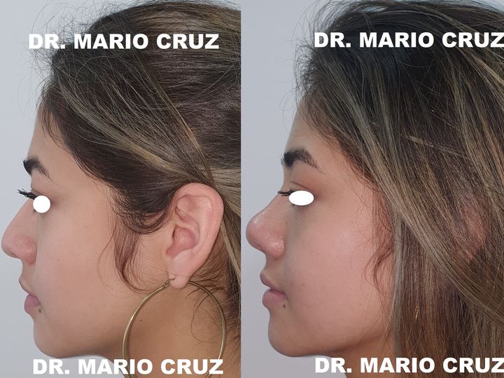 Cirugía de nariz (Rinoplastia) exp22032115092062389520965ac.jpg