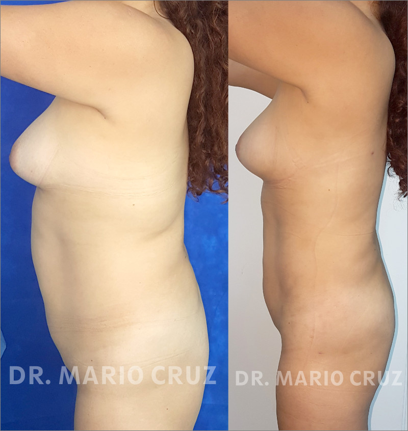 Lipoescultura (Liposucción) liposlateral.jpg