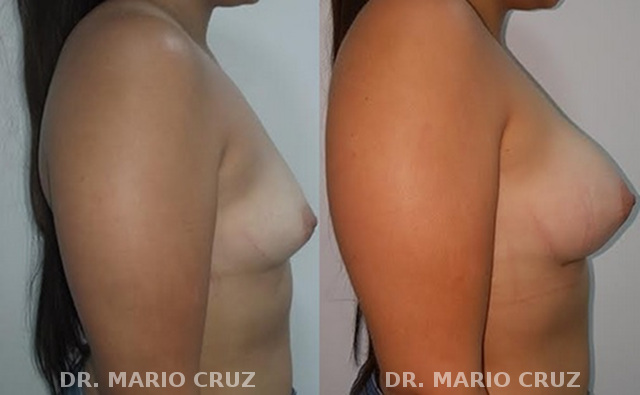 Aumento de senos con implantes mamoplastiadeaumento.jpg