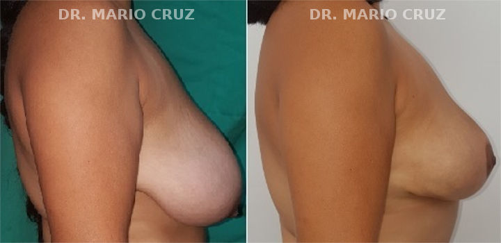 Reducción de senos (Mamoplastia de reducción) mamoplastiadereduccion.jpg