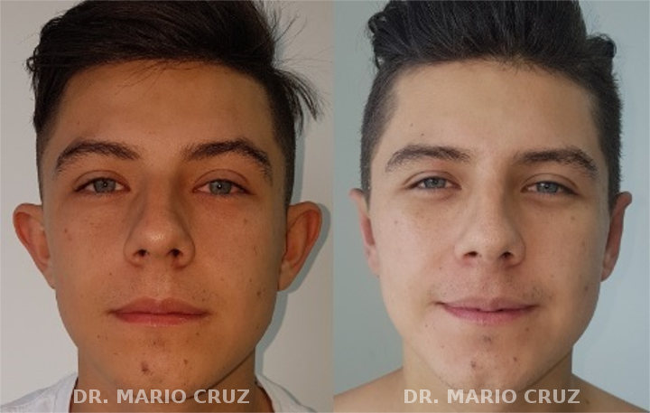 Cirugía de orejas (Otoplastia) otoplastiafrontal.jpg