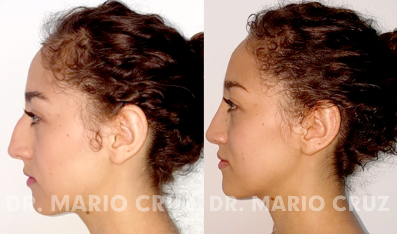 Cirugía de nariz (Rinoplastia) rinop.jpg