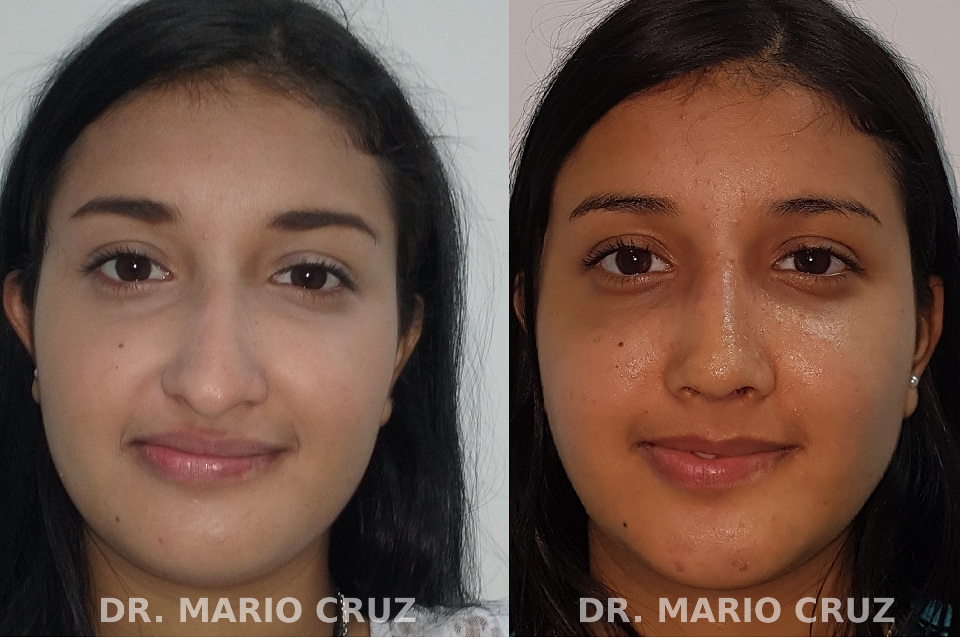 Cirugía de nariz (Rinoplastia) rinoplastia_frontal_1.jpg