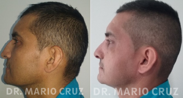 Cirugía de nariz (Rinoplastia) rinoplastiahombre.jpg