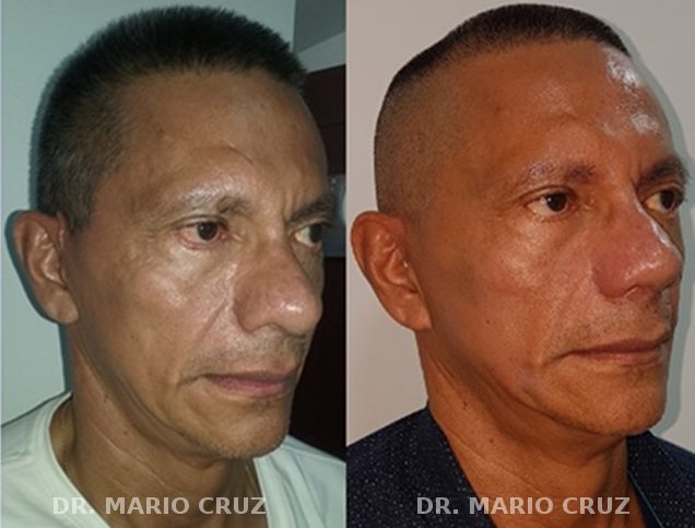 Cirugía de rejuvenecimiento facial (Ritidoplastia) ritidoplastiablefaroplastiarinoplastia.jpg